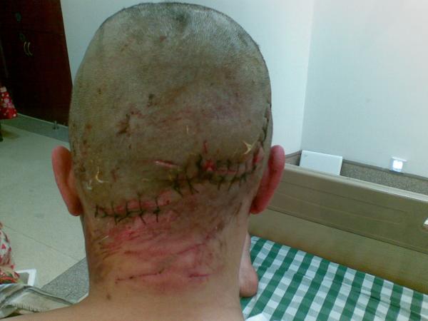 温州金伦藏獒咬人十天后-口水乐园-杭州19楼