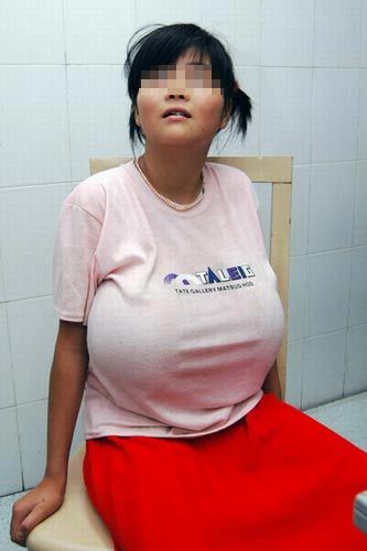 16岁少女患巨乳症双乳重16斤垂到肚脐图